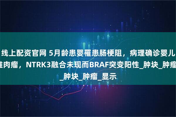 线上配资官网 5月龄患婴罹患肠梗阻，病理确诊婴儿型纤维肉瘤，NTRK3融合未现而BRAF突变阳性_肿块_肿瘤_显示